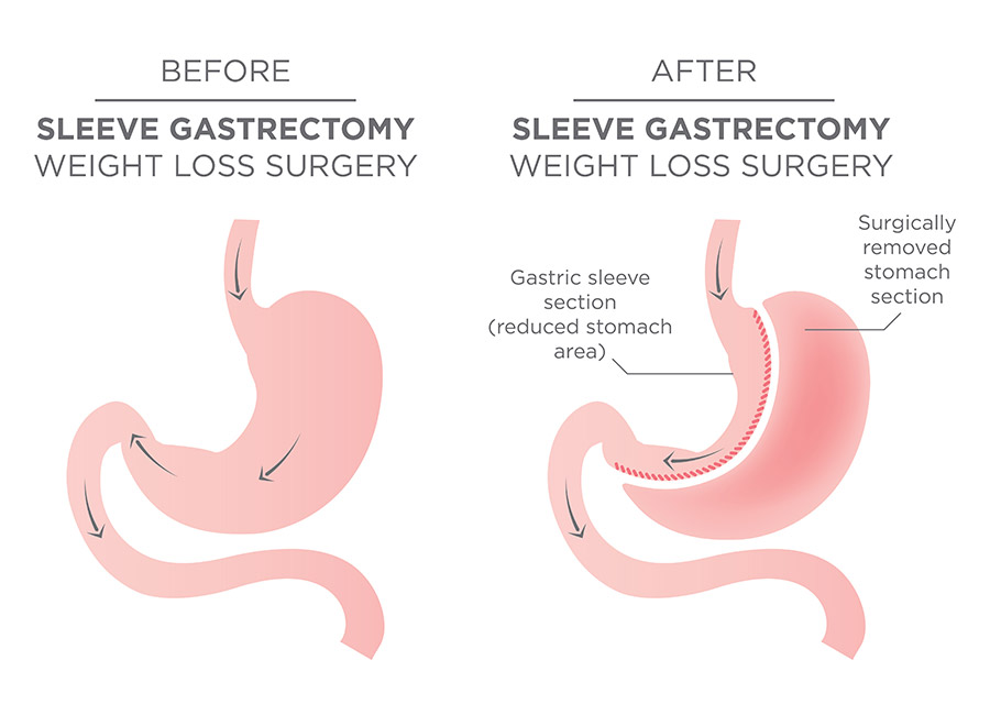 Gastric-Sleeve